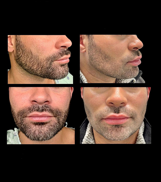 Front and side view of male patient before and after buccal fat pad removal