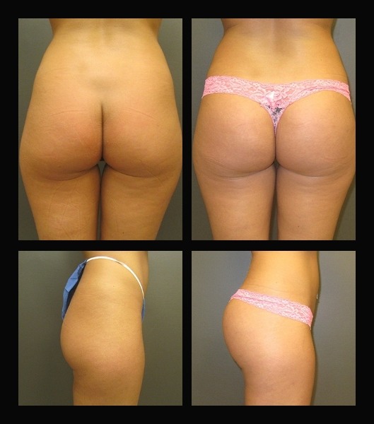 Front and side view of patient before and after buttock augmentation