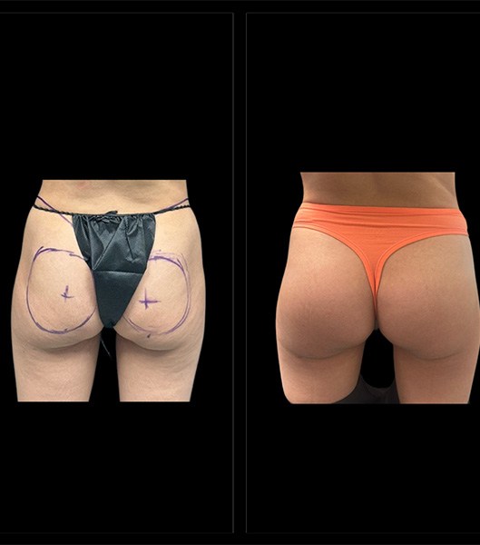 Front and side view of patient before and after buttock augmentation
