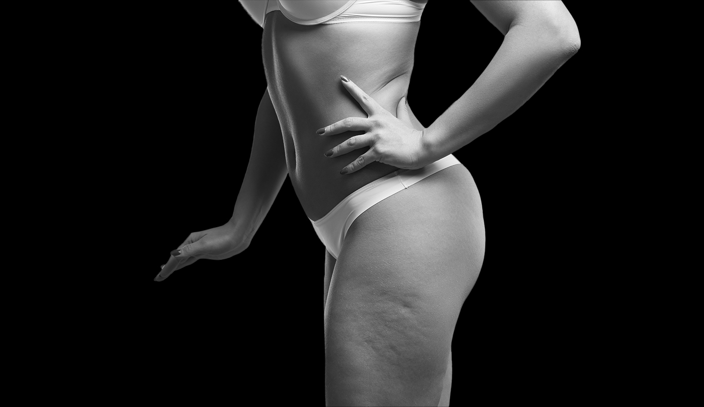 Woman with reduced cellulite from cosmetic surgeon in Chicago.