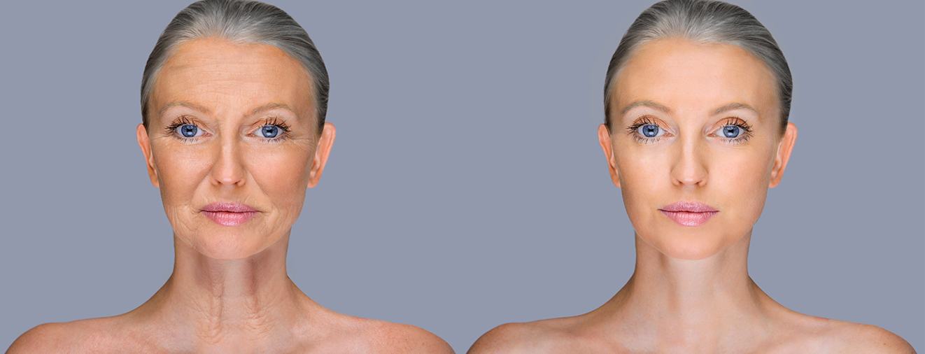 Woman before and after Juvederm filler