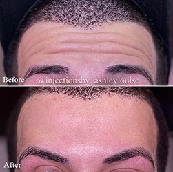 before and after of dysport on forehead