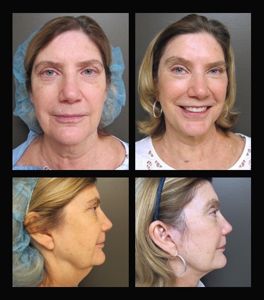 Front and side view of patient before and after facelift