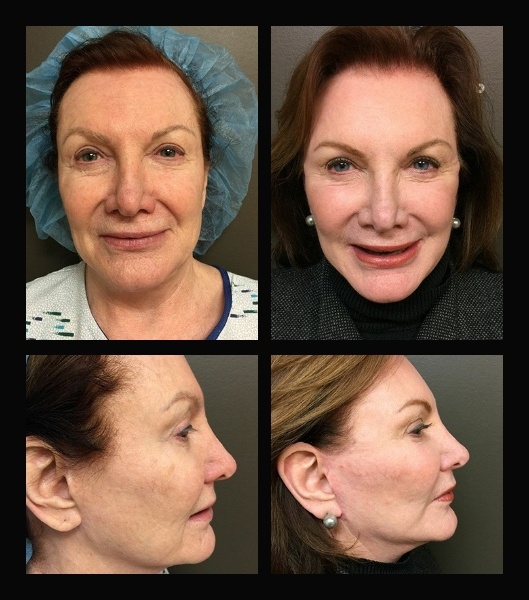 Side and front view ot patient before and after facelift