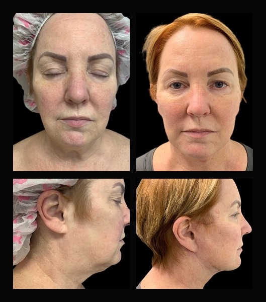 Patient before and after facelift from the front and side