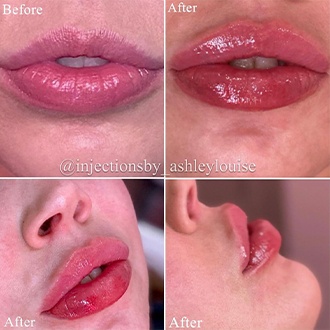 Lips before and after injection treatment
