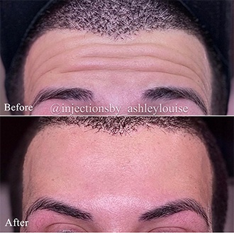 Forehead before and after injection treatment