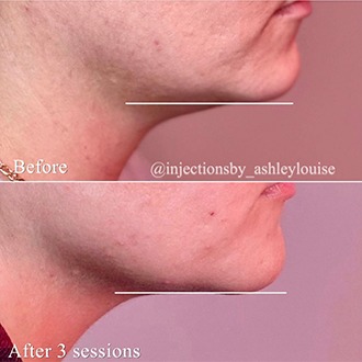 Chin before and after injection treatment
