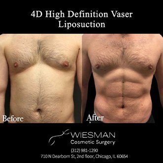 Patient before and after liposuction