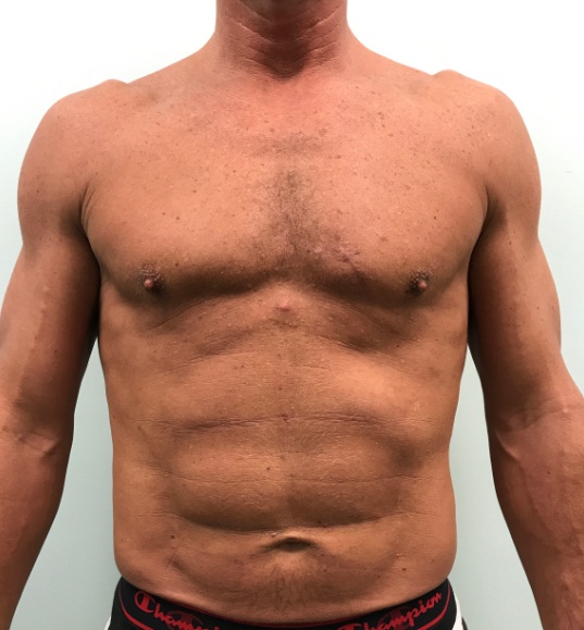 Patient after Vaser 4 D liposculpt