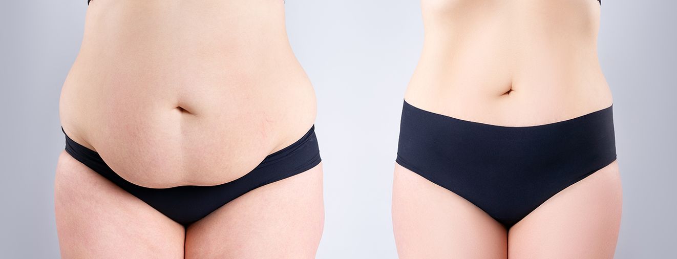 Person before and after liposuction