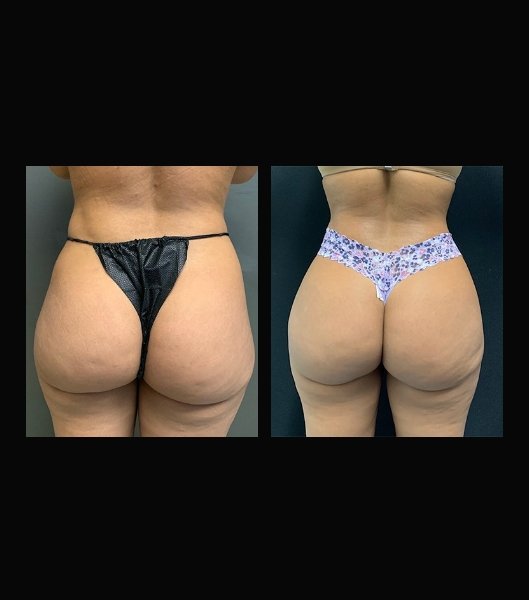 Back view of patient before and after liposuction