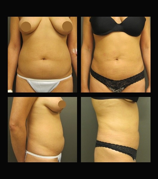 Front and side view of patient before and after liposuction