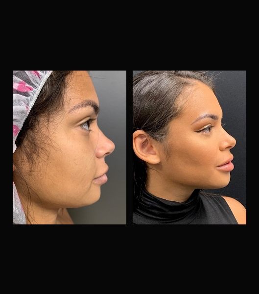 Facial profile of patient before and after liposuction