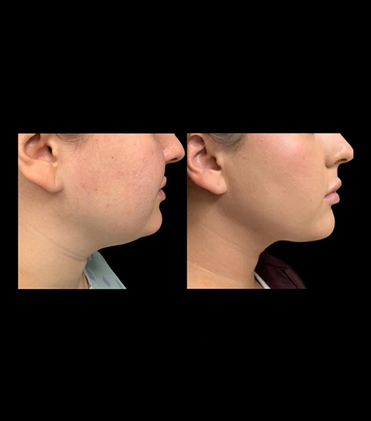 Profile of face before and after liposuction