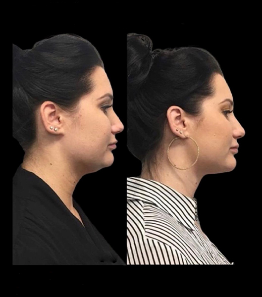 Woman's facial profile before and after liposuction