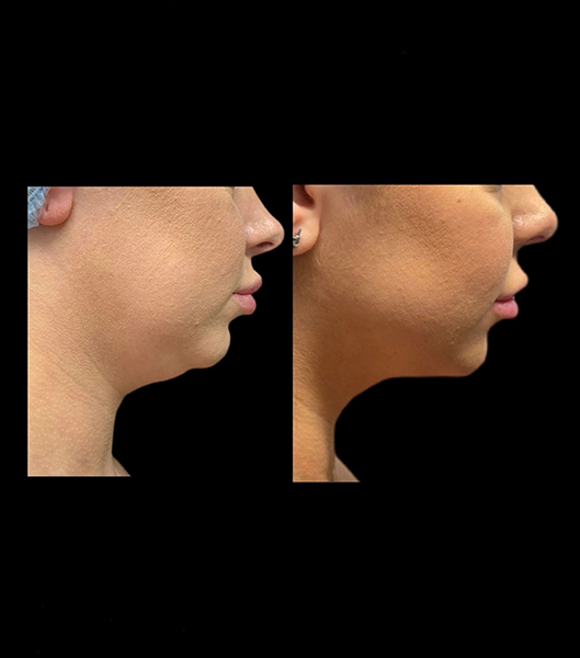 Patient before and after liposuction on chin