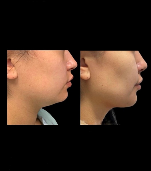 Liposuction patient before and after facial profile