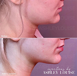 before and after Kybella on chin