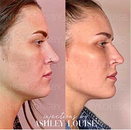 Patient before and after Kybella