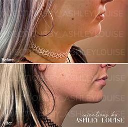 before and after Kybella on chin