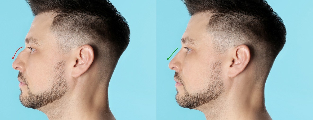 Man's profile before and after a nose job