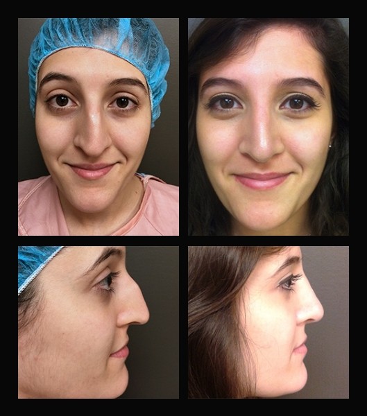 Front and side view of patient before and after nose job