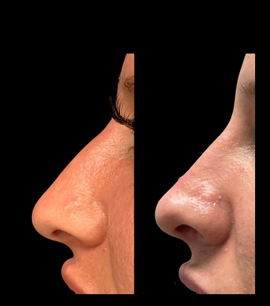 Side view of patient before and after nose job