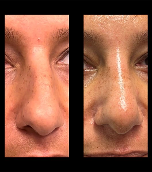 Side view of patient before and after nose job