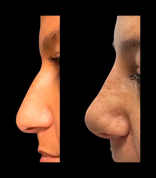 Side view of patient before and after nose job
