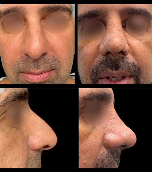 Side view of patient before and after nose job