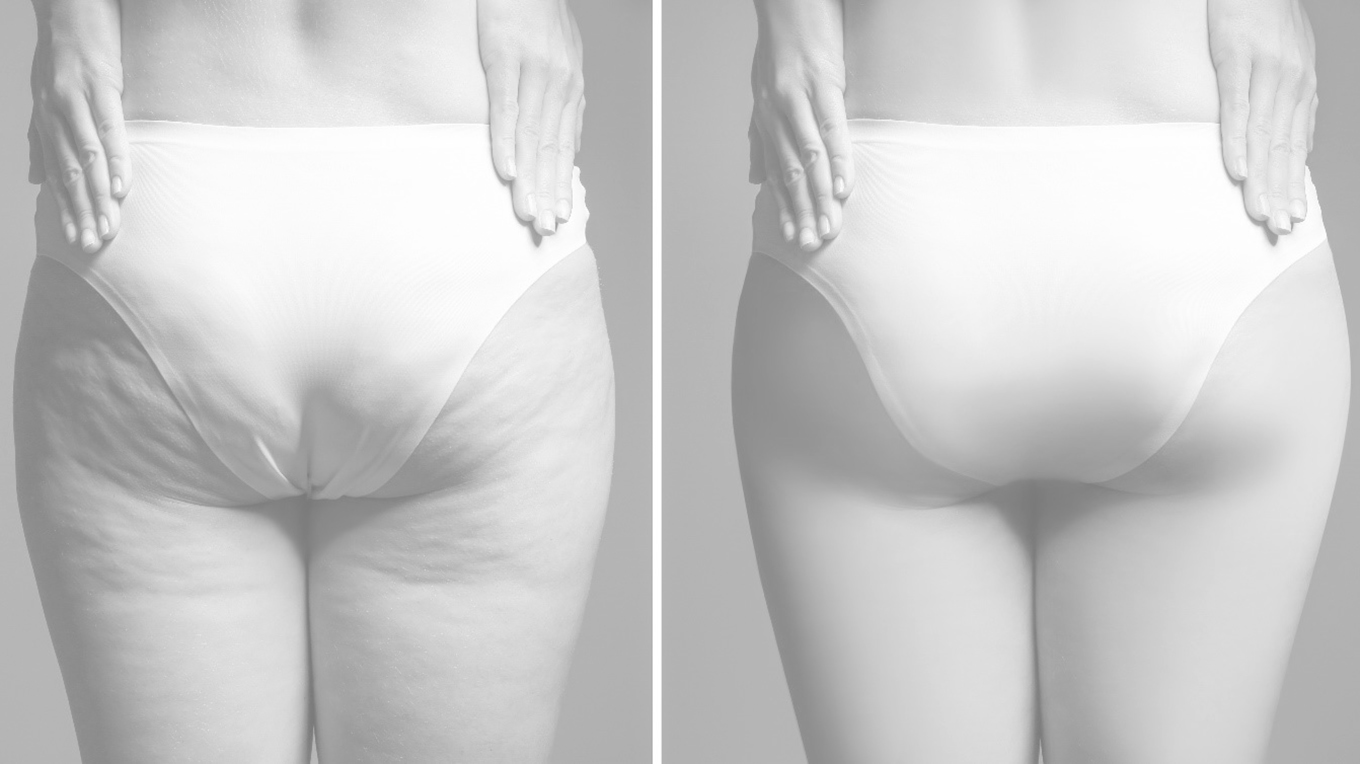 Woman’s backside before and after thigh lift procedure