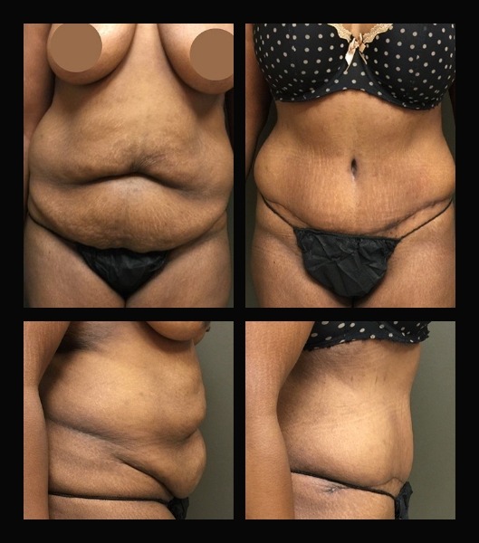 View of tummy tuck patient from the front and side before and after treatment