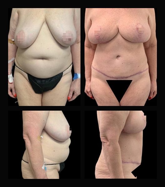 Patient before and after tummy tuck treatment