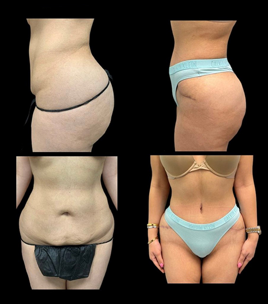 Patient before and after tummy tuck procedure