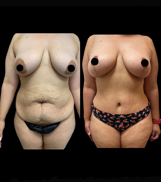 Front view of patient before and after tummy tuck