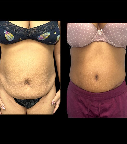 Front view of patient before and after tummy tuck