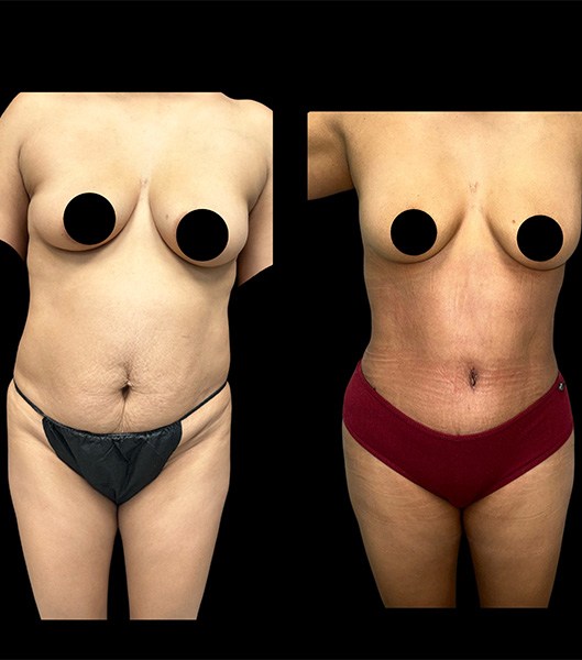 Front view of patient before and after tummy tuck