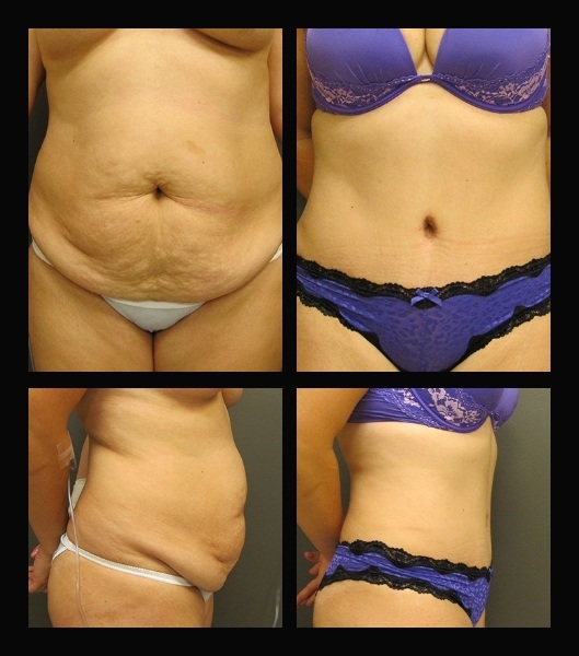 Front and side view of patient before and after tummy tuck