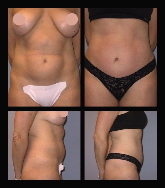 Side and front view of patient before and after tummy tuck