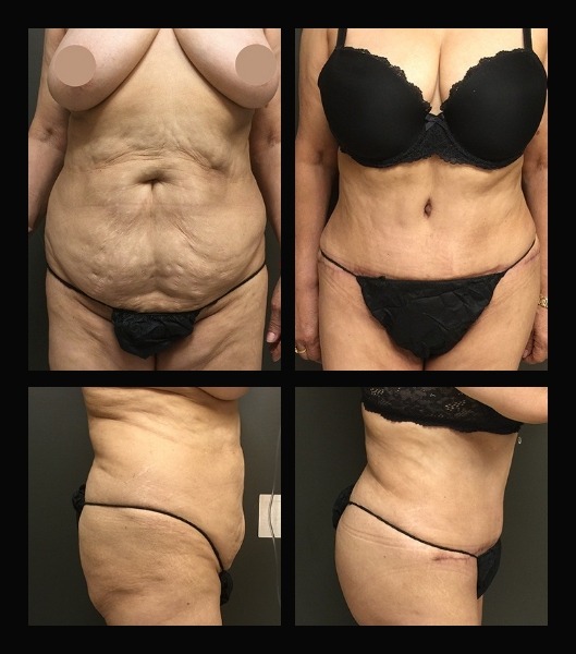 Profile and front view of patient before and after tummy tuck
