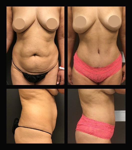 Front and profile view of patient before and after tummy tuck
