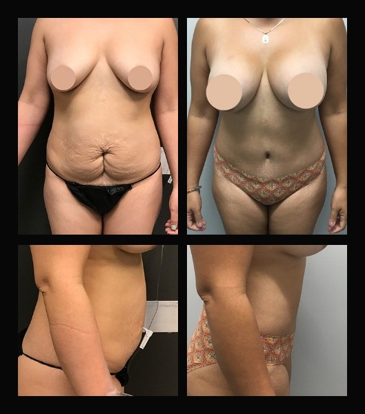 Tummy tuck patient front and side view before and after treatment