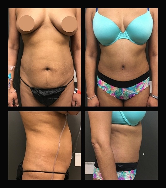 Tummy tuck patient side and front view before and after treatment