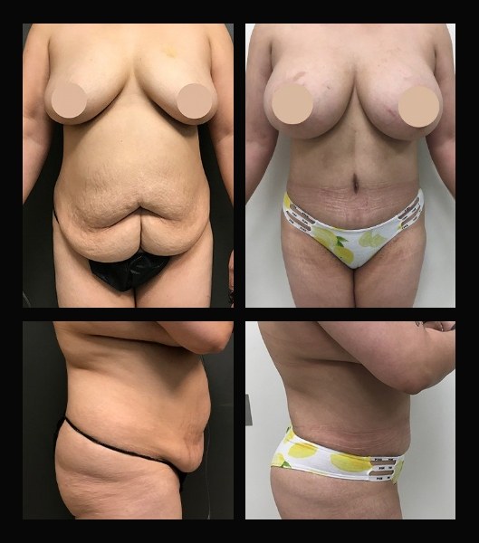 Tummy tuck patient front and profile view before and after treatment