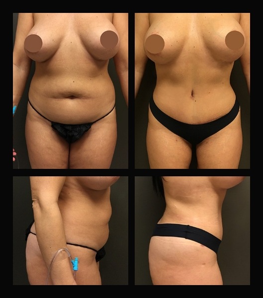 Tummy tuck patient profiel and front view before and after treatment
