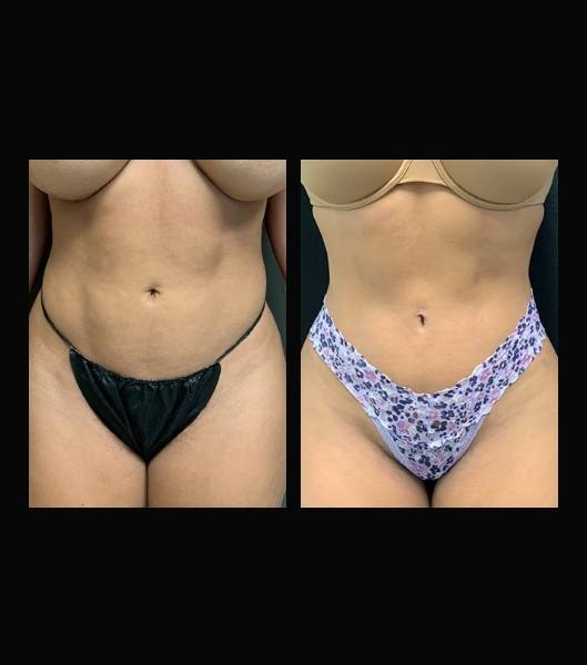 Patient before and after Vaser 4 D liposculpt