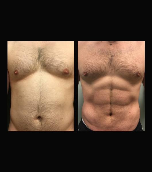 Male patient before and after vaser 4 D liposculpt