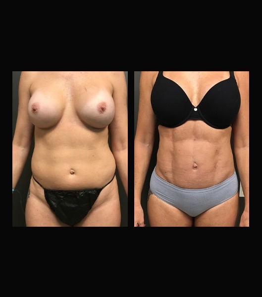 Woman before and after vaser 4 D liposculpt