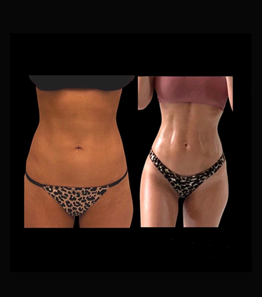 Woman's abdomen before and after vaser 4 D liposculpt